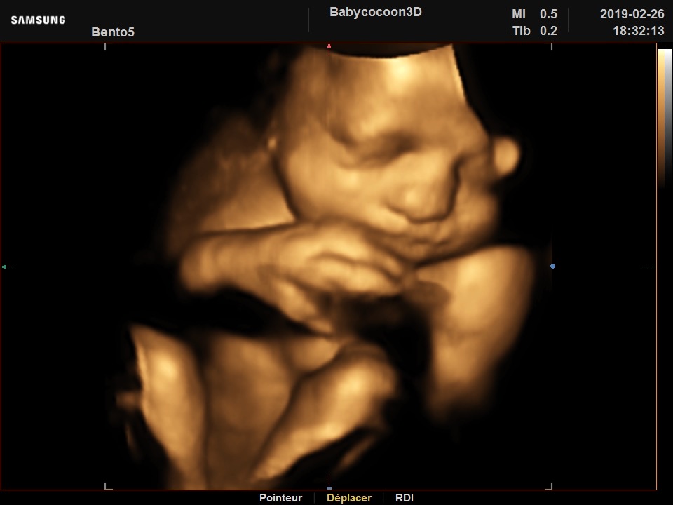 60 idées de Echographie bebe 2020  echographie bebe, échographie, bebe