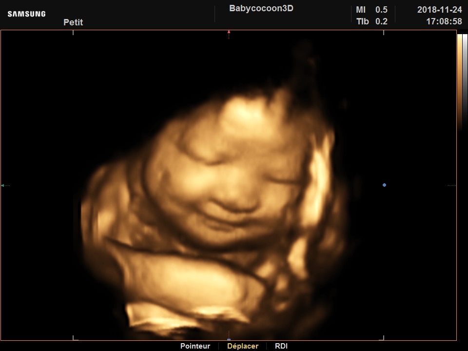 Babycocoon 3d Institut D Echographie 3d Prenatale A Nyon Babycocoon 3d Institut D Echographie 3d Prenatale A Nyon